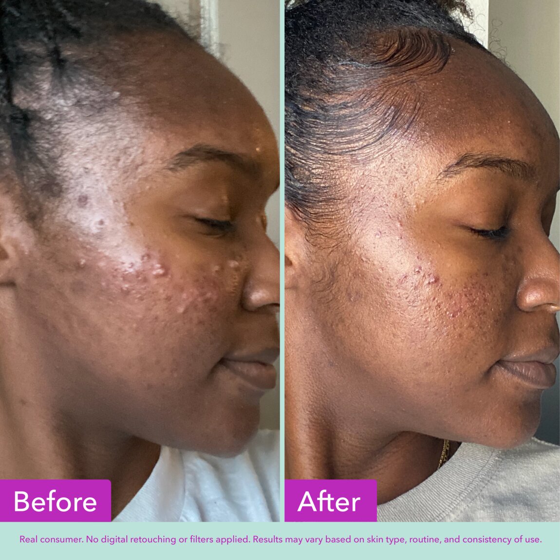 acne-foaming-cleanser-c8 zb_p.jpg